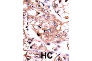 Formalin-fixed and paraffin-embedded human cancer tissue reacted with the primary antibody, which was peroxidase-conjugated to the secondary antibody, followed by AEC staining. (PPP2CA antibody  (C-Term))