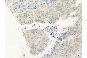 ABIN6259919 and ABIN6269342 at 1/100 staining human cervical carcinoma by IHC-P. (PRKAA1 antibody  (C-Term))
