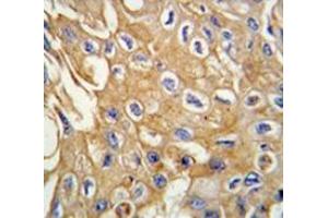 Immunohistochemistry analysis in human lung carcinoma tissue (Formalin-fixed, Paraffin-embedded) using RIPK3 / RIP3  Antibody , followed by peroxidase-conjugated secondary antibody and DAB staining.