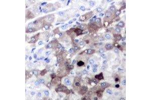 Immunohistochemical analysis of SGTA staining in human liver cancer formalin fixed paraffin embedded tissue section.
