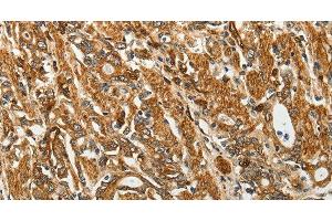 Immunohistochemistry of paraffin-embedded Human gastic cancer using RPLP0 Polyclonal Antibody at dilution of 1:40 (RPLP0 antibody)