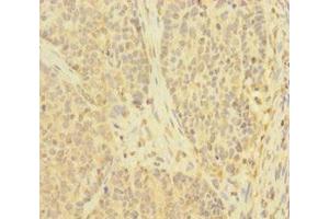 Immunohistochemistry of paraffin-embedded human ovarian cancer using ABIN7173908 at dilution of 1:100 (TNFAIP6 antibody  (AA 18-277))