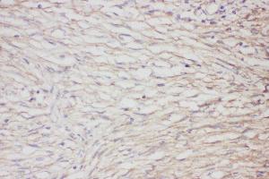 Anti-GFAP Picoband antibody,  IHC(P): Human meningioma Tissue (GFAP antibody  (AA 93-432))