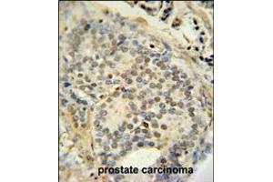 FUS antibody immunohistochemistry analysis in formalin fixed and paraffin embedded human prostate carcinoma followed by peroxidase conjugation of the secondary antibody and DAB staining. (FUS antibody  (C-Term))