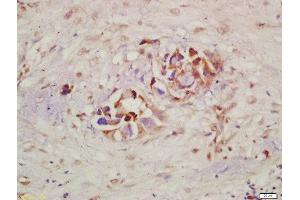 Formalin-fixed and paraffin embedded human lung carcinoma labeled with Rabbit Anti-c-Kit(Tyr721) Polyclonal Antibody, Unconjugated  at 1:200 followed by conjugation to the secondary antibody and DAB staining (KIT antibody  (pTyr721))