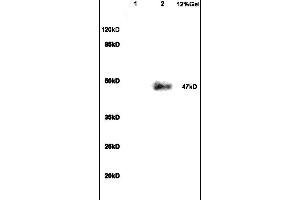 Formalin-fixed and paraffin embedded human colon carcinoma labeled with Anti VIP Receptor 1/VAPC1 Polyclonal Antibody, Unconjugated (ABIN872880) at 1:200 followed by conjugation to the secondary antibody and DAB staining (VIPR1 antibody  (AA 351-457))