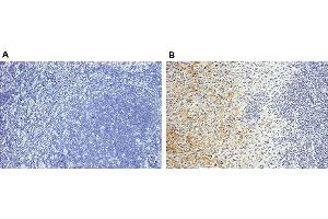 Staining of endogenous human Periostin in human breast cancer tissues (paraffin sections) by using Periostin, mAb (Stiny-1) . (Periostin antibody  (full length))