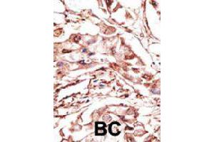 Formalin-fixed and paraffin-embedded human cancer tissue reacted with DKK4 polyclonal antibody  , which was peroxidase-conjugated to the secondary antibody, followed by DAB staining. (DKK4 antibody  (AA 162-189))