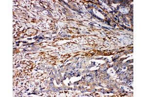 Anti-VRL1 antibody, IHC(P) IHC(P): Human Mammary Cancer Tissue (TRPV2 antibody  (N-Term))