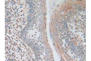 IHC-P analysis of Human Skin Cancer Tissue, with DAB staining. (AKT3 antibody  (AA 46-338))