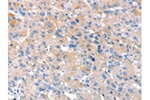 The image on the left is immunohistochemistry of paraffin-embedded Human liver cancer tissue using ABIN7130903(RNF214 Antibody) at dilution 1/20, on the right is treated with fusion protein. (RNF214 antibody)