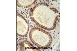 TR antibody (C-term) (ABIN652176 and ABIN2840578) immunohistochemistry analysis in formalin fixed and paraffin embedded human prostate carcinoma followed by peroxidase conjugation of the secondary antibody and DAB staining. (TRAM2 antibody  (C-Term))