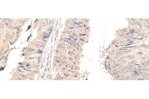 Immunohistochemistry of paraffin-embedded Human lung cancer tissue using OLA1 Polyclonal Antibody at dilution of 1:45(x200) (OLA1 antibody)