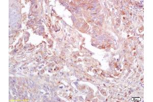 Formalin-fixed and paraffin embedded human lung carcinoma labeled with Anti-GnRHR Polyclonal Antibody, Unconjugated  at 1:200 followed by conjugation to the secondary antibody and DAB staining (FAK antibody  (pTyr397))