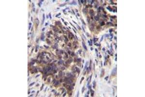 Immunohistochemistry analysis in formalin fixed and paraffin embedded human lung carcinoma reacted with Alpha-glucosidase Antibody (N-term) followed by peroxidase conjugation of the secondary antibody and DAB staining. (AGLU antibody  (N-Term))