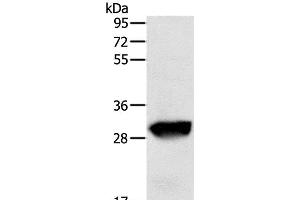 Western Blot analysis of Human liver cancer tissue using GSTO1 Polyclonal Antibody at dilution of 1:200 (GSTO1 antibody)