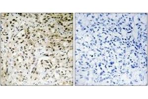 Immunohistochemistry analysis of paraffin-embedded human liver carcinoma tissue, using TAF5 Antibody. (TAF5 antibody  (AA 381-430))