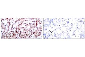 Immunohistochemical analysis of paraffin-embedded human breast carcinoma tissue using ATF-2 (phospho-Thr73 or 55) antibody (E011032). (ATF2 antibody  (pThr55, pThr73))