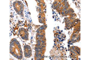 Immunohistochemistry of Human colon cancer using NCK1 Polyclonal Antibody at dilution of 1:30