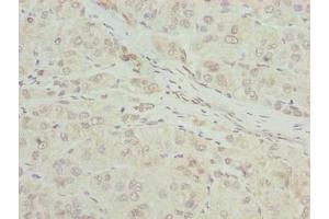 Immunohistochemistry of paraffin-embedded human liver cancer using ABIN7168087 at dilution of 1:100 (RIBC2 antibody  (AA 1-309))