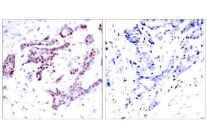 Immunohistochemical analysis of paraffin-embedded human breast carcinoma tissue using STAT1 (phospho-Tyr701) antibody (E011044). (STAT1 antibody  (pTyr701))