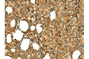 The image on the left is immunohistochemistry of paraffin-embedded Human thyroid cancer tissue using ABIN7130886(RLN1 Antibody) at dilution 1/20, on the right is treated with fusion protein. (Relaxin 1 antibody)