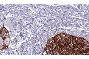 ABIN6268911 at 1/100 staining Human urothelial cancer tissue by IHC-P. (Claudin 11 antibody  (C-Term))