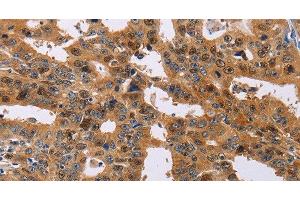 Immunohistochemistry of paraffin-embedded Human gasrtic cancer tissue using NIF3L1 Polyclonal Antibody at dilution 1:30 (NIF3L1 antibody)