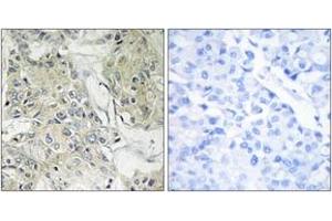 Immunohistochemistry analysis of paraffin-embedded human breast carcinoma tissue, using TM16J Antibody. (ANO9 antibody  (AA 481-530))