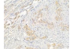 ABIN6263936 and ABIN6266609 at 1/100 staining human tongue carcinoma by IHC-P.
