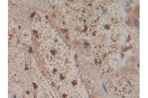 Detection of CORO1A in Human Lung cancer Tissue using Polyclonal Antibody to Coronin 1A (CORO1A) (Coronin 1a antibody  (AA 7-204))