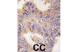 Formalin-fixed and paraffin-embedded human colon carcinoma tissue reacted with TRAF2 polyclonal antibody  , which was peroxidase-conjugated to the secondary antibody, followed by DAB staining. (TRAF2 antibody  (C-Term))