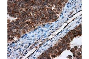 Immunohistochemical staining of paraffin-embedded Adenocarcinoma of breast tissue using anti-TPMT mouse monoclonal antibody. (TPMT antibody)