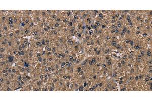 Immunohistochemistry of paraffin-embedded Human liver cancer tissue using FGF7 Polyclonal Antibody at dilution of 1:30 (FGF7 antibody)