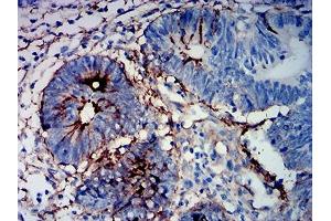 Immunohistochemical analysis of paraffin-embedded rectum cancer tissues using MUC16 mouse mAb with DAB staining.