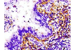 IHC image of ABIN7172220 diluted at 1:100 and staining in paraffin-embedded human lung cancer performed on a Leica BondTM system. (Titin antibody  (AA 5398-5604))