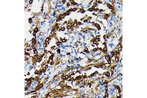 Immunohistochemistry of paraffin-embedded human lung cancer using SFTP Rabbit pAb (ABIN3017436, ABIN3017437, ABIN3017438 and ABIN6220091) at dilution of 1:50 (40x lens). (Surfactant Protein A1 antibody)