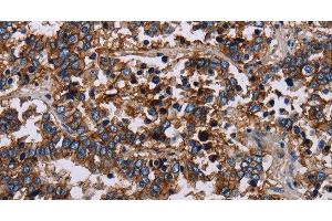 Immunohistochemistry of paraffin-embedded Human liver cancer using JAM-A Polyclonal Antibody at dilution of 1:40 (F11R antibody)