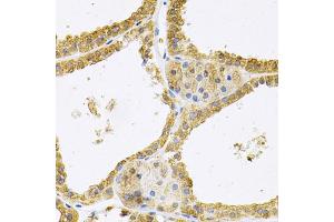 Immunohistochemistry of paraffin-embedded human thyroid cancer using FHL1 Antibody (ABIN1876648) at dilution of 1:100 (40x lens). (FHL1 antibody)