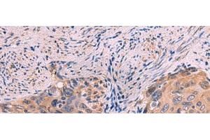 Immunohistochemistry of paraffin-embedded Human cervical cancer tissue using PPEF1 Polyclonal Antibody at dilution of 1:100(x200) (PPEF1 antibody)
