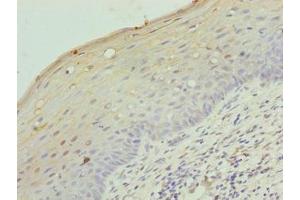 Immunohistochemistry of paraffin-embedded human cervical cancer using ABIN7158142 at dilution of 1:100 (LRRC18 antibody  (AA 1-261))