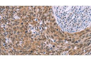 Immunohistochemistry of paraffin-embedded Human cervical cancer tissue using GLYR1 Polyclonal Antibody at dilution 1:30 (GLYR1 antibody)