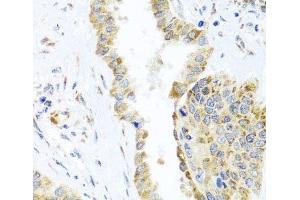 Immunohistochemistry of paraffin-embedded Human lung cancer using DARS2 Polyclonal Antibody at dilution of 1:100 (40x lens). (DARS2 antibody)