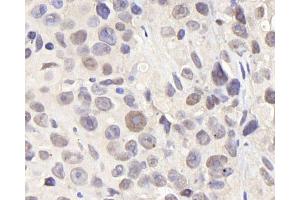 Immunohistochemistry analysis of paraffin-embedded Mouse breast cancer using CDC25A Polyclonal Antibody at dilution of 1:1000. (CDC25A antibody)