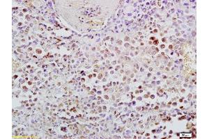 Formalin-fixed and paraffin embedded mouse lymphoma labeled with Anti-Phospho-NFKB p65(Ser276) Polyclonal Antibody, Unconjugated (ABIN700555) at 1:200, followed by conjugation to the secondary antibody and DAB staining (NF-kB p65 antibody  (pSer276))