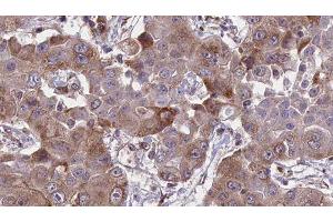 ABIN6276655 at 1/100 staining Human liver cancer tissue by IHC-P. (HFE antibody  (Internal Region))