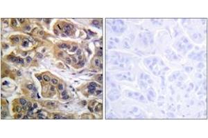 Immunohistochemistry analysis of paraffin-embedded human breast carcinoma tissue, using HER3 (Ab-1289) Antibody. (ERBB3 antibody  (AA 1256-1305))