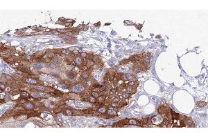 ABIN6277437 at 1/100 staining Human Head and neck cancer tissue by IHC-P. (TRAF7 antibody  (N-Term))