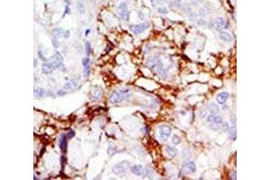 IHC analysis of FFPE human breast carcinoma tissue stained with the PAK3 antibody (PAK3 antibody  (AA 218-247))