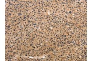 The image on the left is immunohistochemistry of paraffin-embedded Human liver cancer tissue using ABIN7189683(ADIPOR2 Antibody) at dilution 1/15, on the right is treated with synthetic peptide. (Adiponectin Receptor 2 antibody)